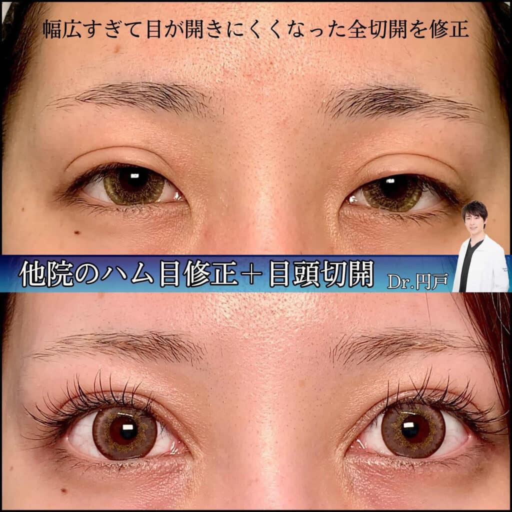 eclinic富山駅前院の全切開二重術の他院修正（ハム目修正）