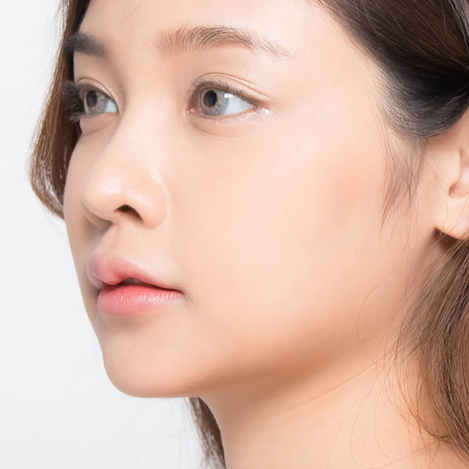 埋没法の手術を受けた女性