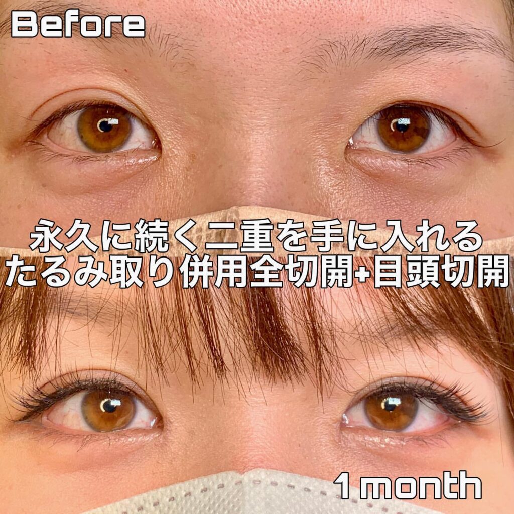 eclinic富山駅前院のたるみ取り併用全切開二重術＋目頭切開