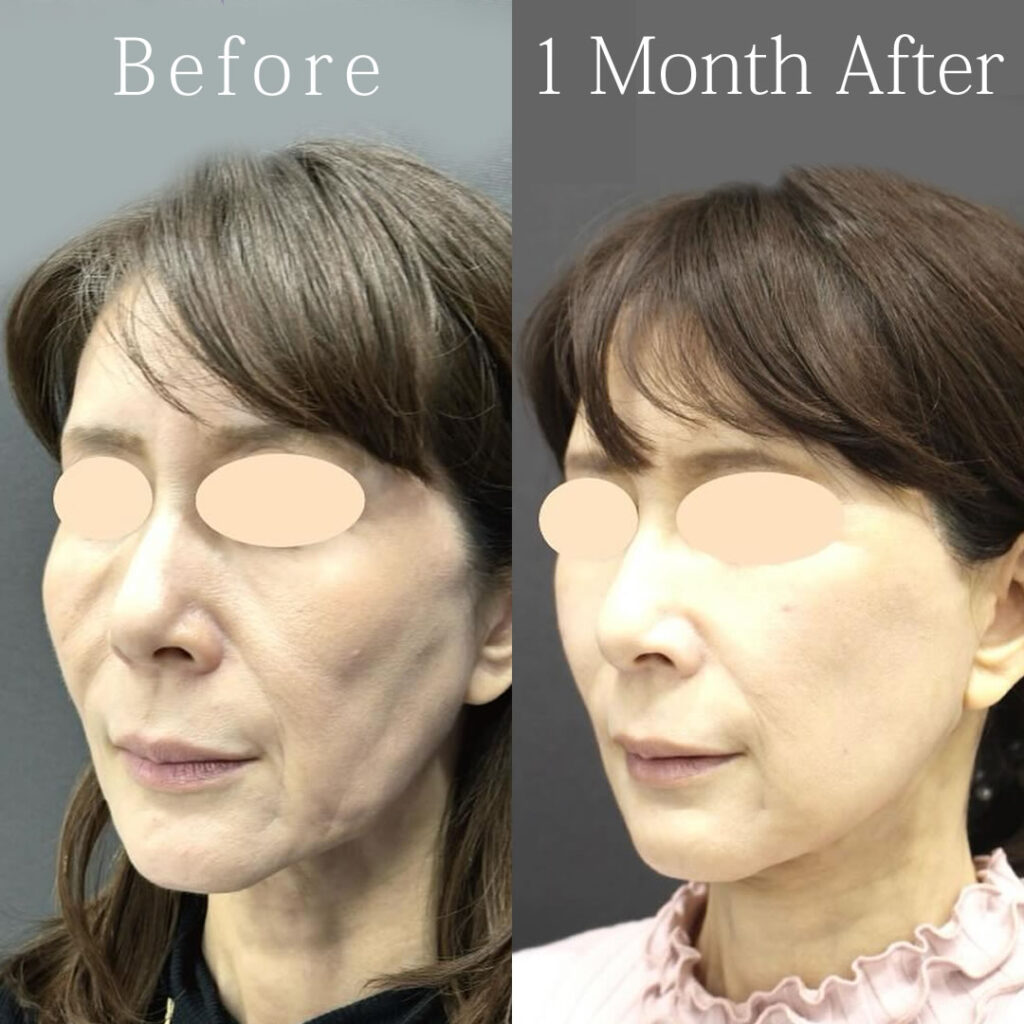 スマスフェイスリフトとネックリフトとミッドフェイスリフトを同時に行った症例写真