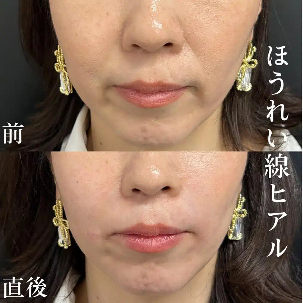 ほうれい線ヒアルロン酸