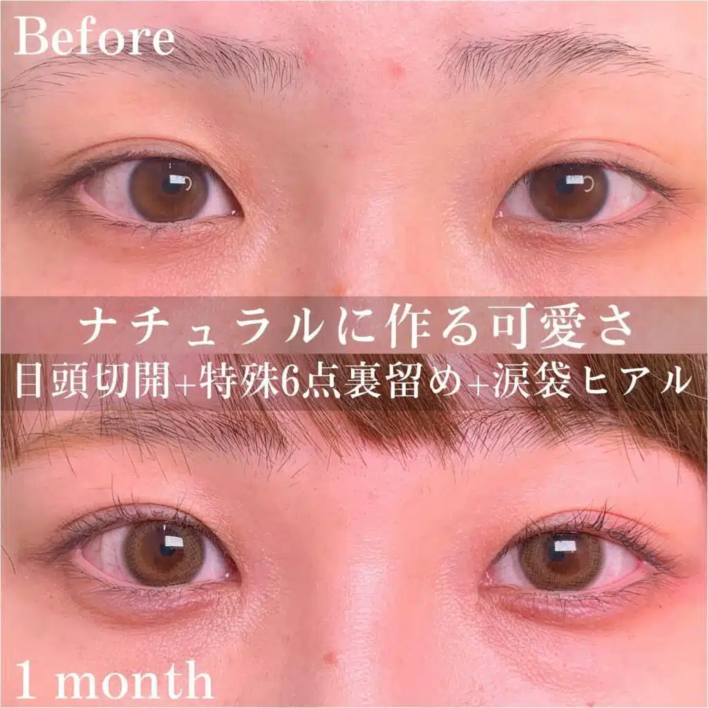 目頭切開 特殊6点裏留め 涙袋ヒアル