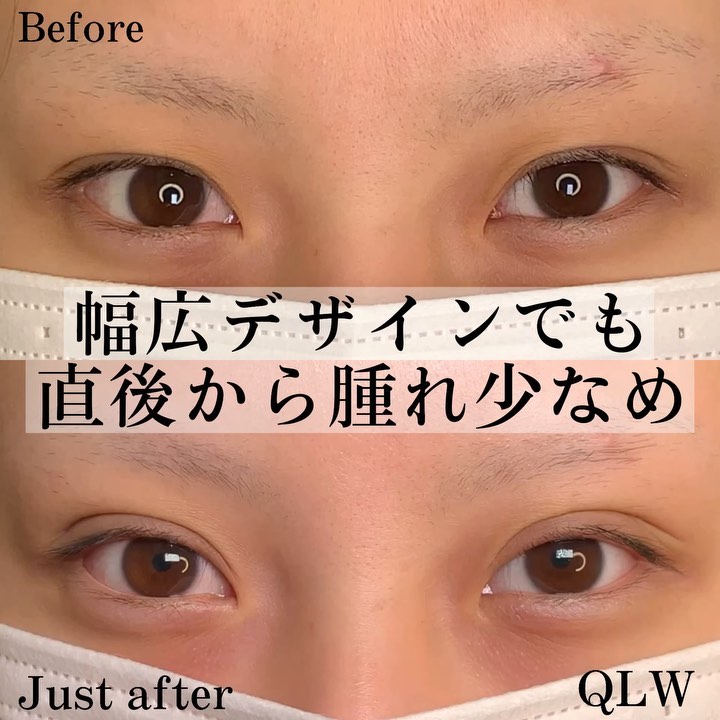 eclinic富山駅前院の二重埋没法（クイックダブルループ法）（裏留め4点）