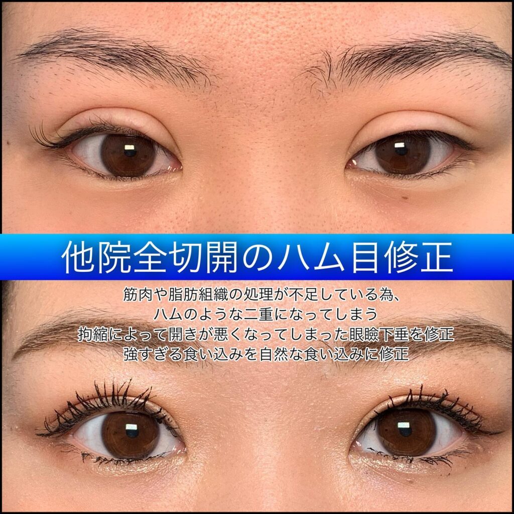 eclinic富山駅前院の全切開二重術の他院修正（ハム目修正）