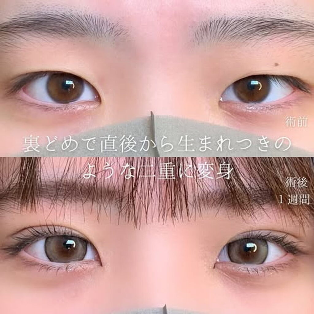 eclinic富山駅前院の二重埋没法