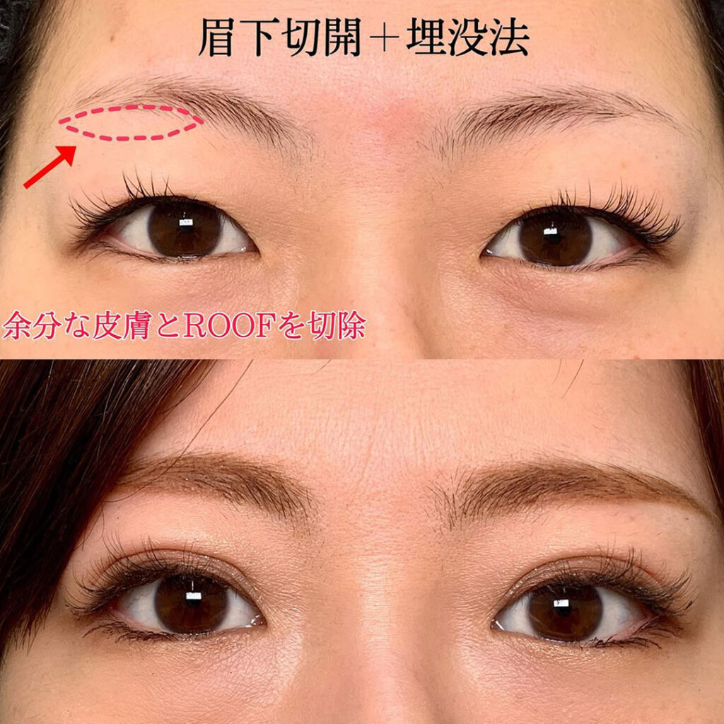 eclinic富山駅前院の二重埋没法＋眉下切開