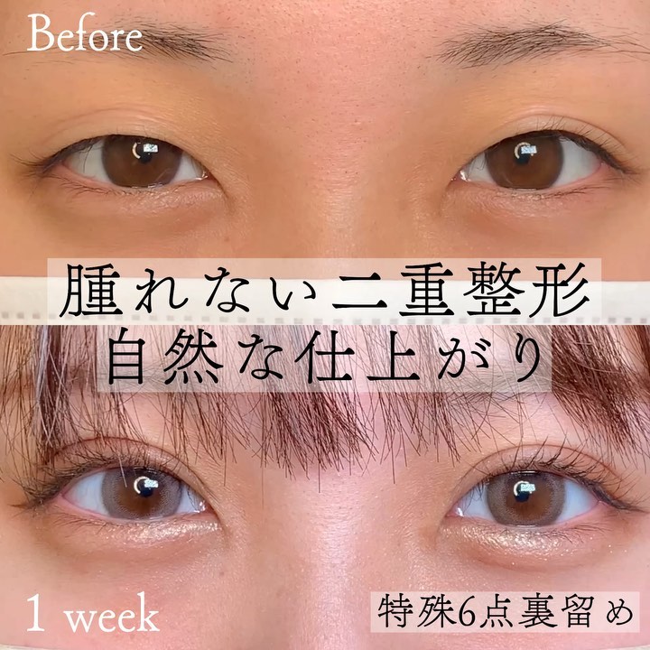 eclinic富山駅前院の二重埋没法（特殊6点裏留め）