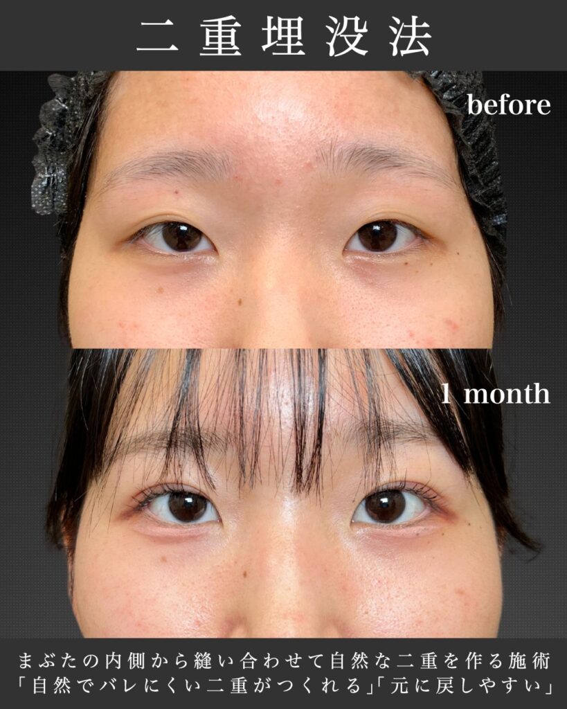 eclinic富山駅前院の二重埋没法