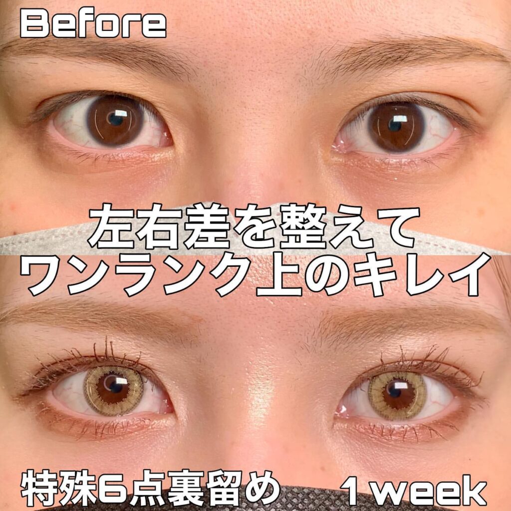 eclinic富山駅前院の二重埋没法（特殊6点裏留め）