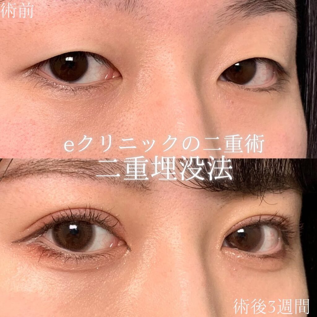 eclinic富山駅前院の二重埋没法