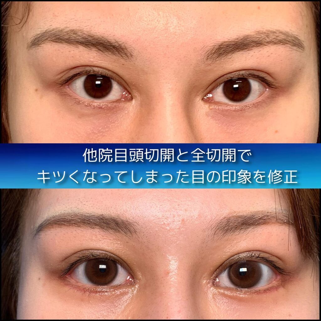 eclinic富山駅前院の全切開二重術の他院修正＋眼瞼下垂