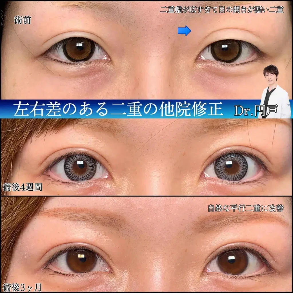 eclinic富山駅前院の全切開二重術の他院修正