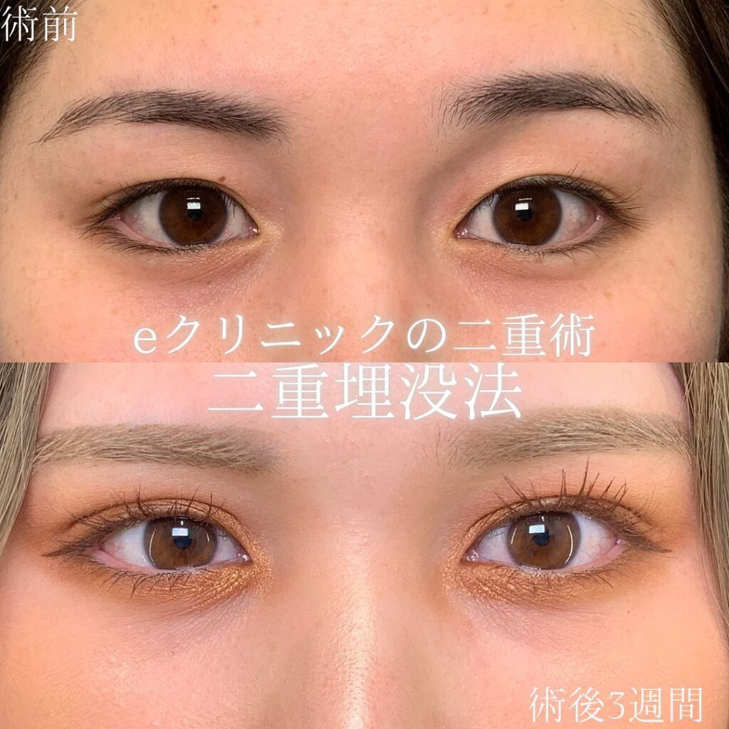 eclinic富山駅前院の二重埋没法