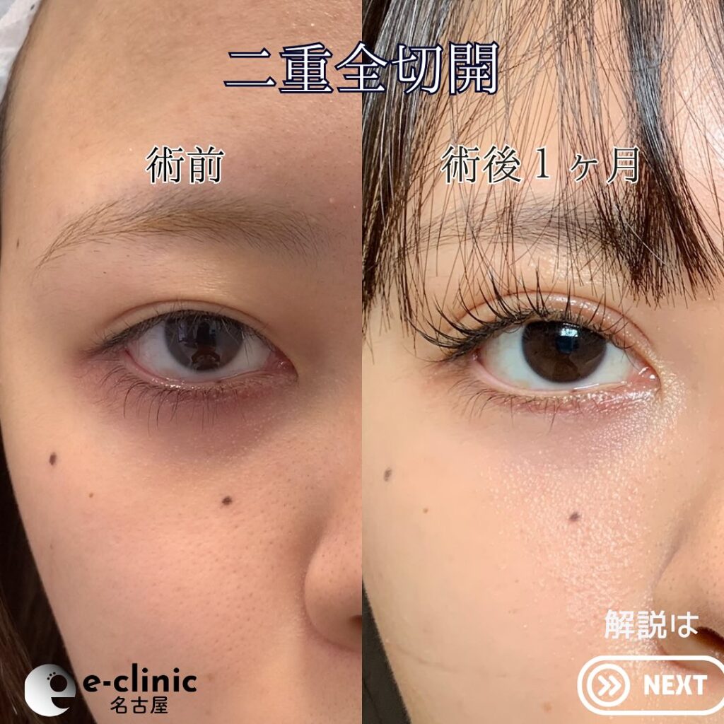 eclinic富山駅前院の全切開二重術