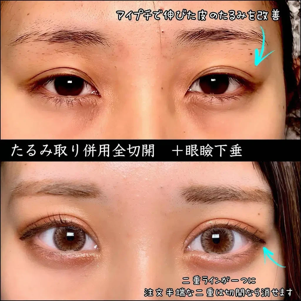 eclinic富山駅前院のたるみ取り併用全切開二重術＋眼瞼下垂