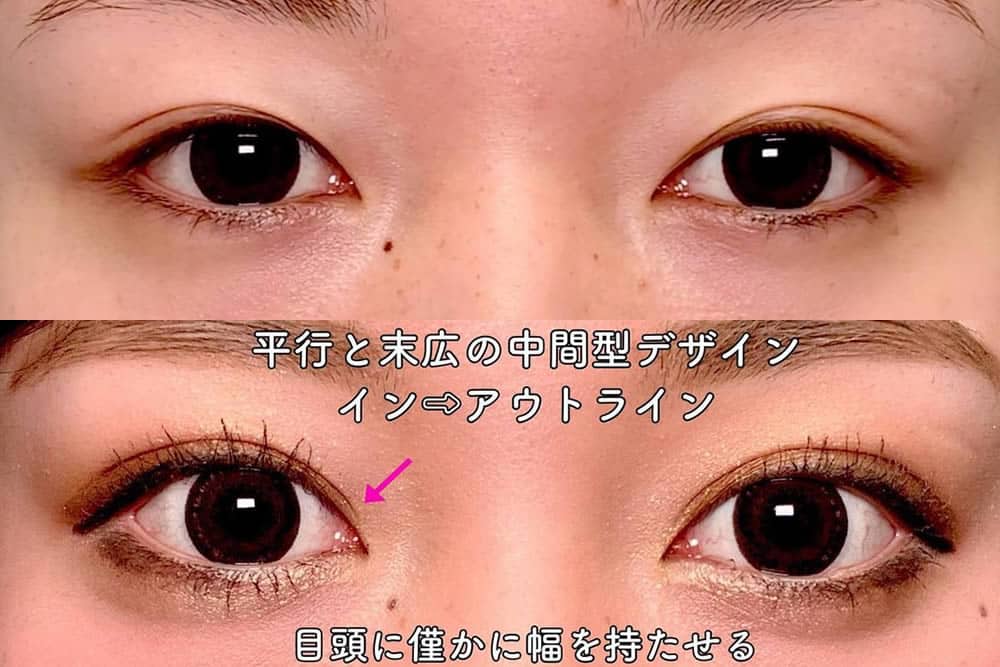 eclinic富山駅前院の二重埋没法