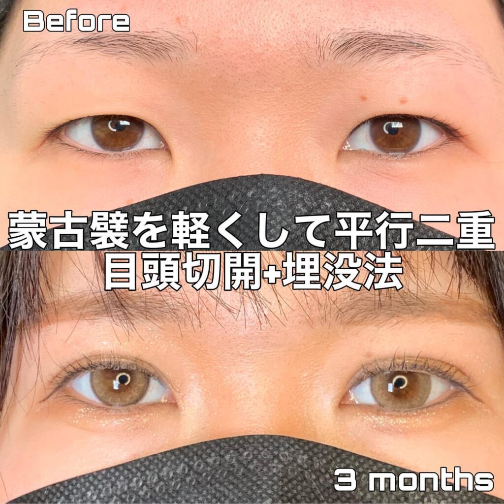 eclinic富山駅前院の二重埋没法＋目頭切開