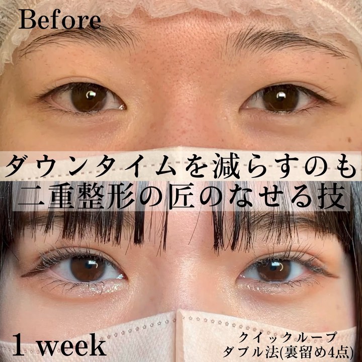 eclinic富山駅前院の二重埋没法（クイックダブルループ法）（裏留め4点）