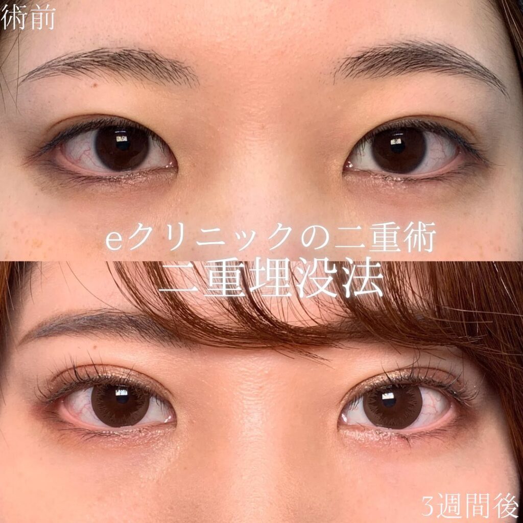 eclinic富山駅前院の二重埋没法