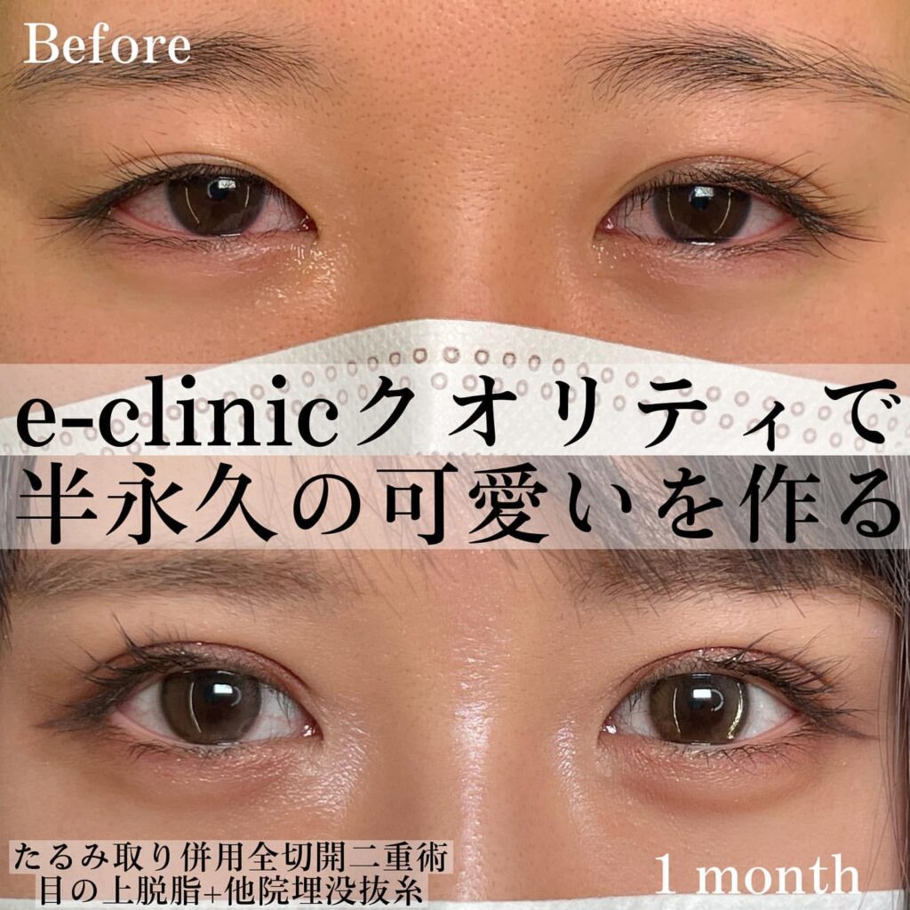 eclinic富山駅前院のたるみ取り併用全切開二重術＋目の上脱脂＋他院埋没