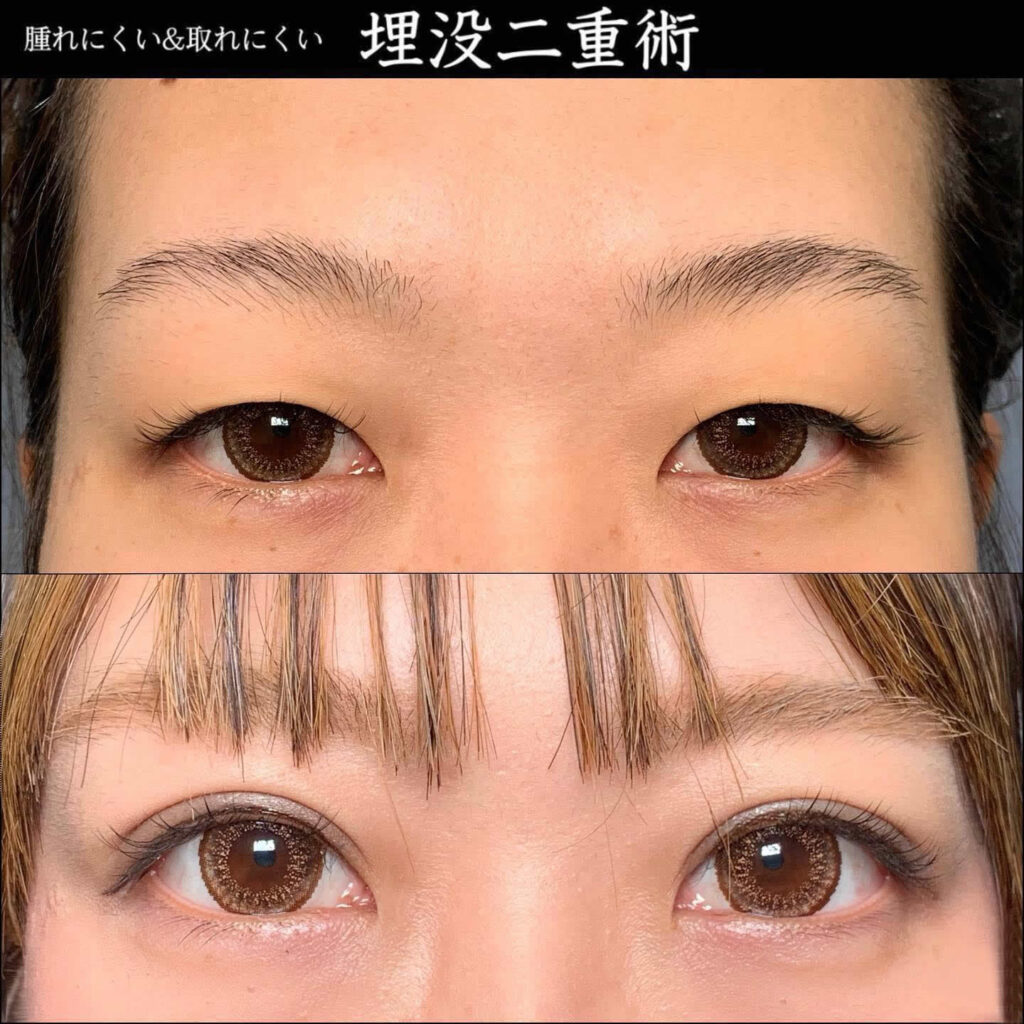 eclinic富山駅前院の二重埋没法