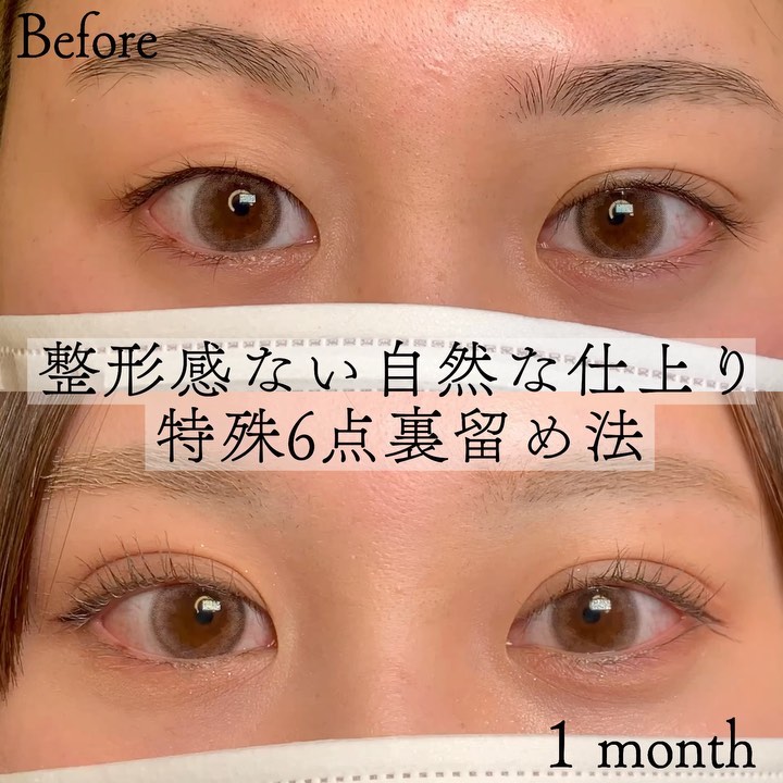 eclinic富山駅前院の二重埋没法（特殊6点裏留め法）