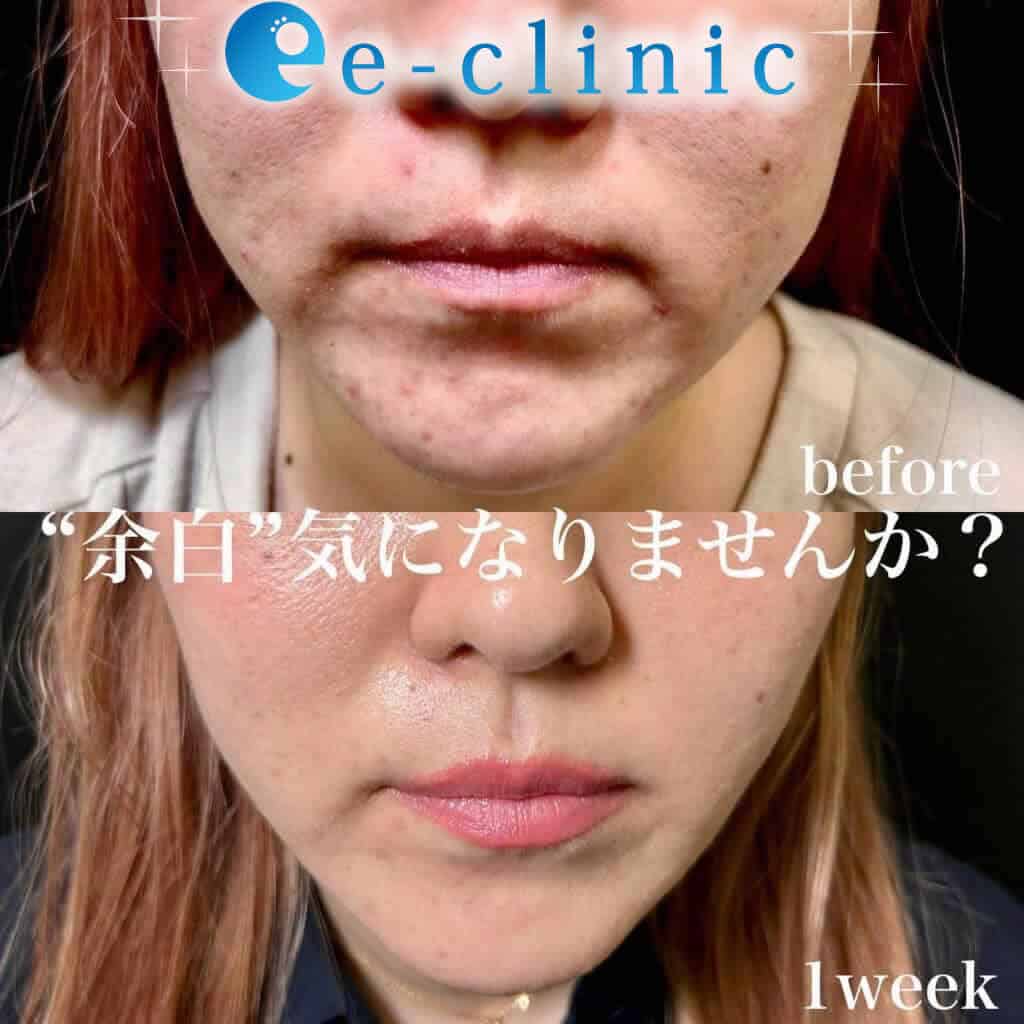 ハイブリッドリフトの症例