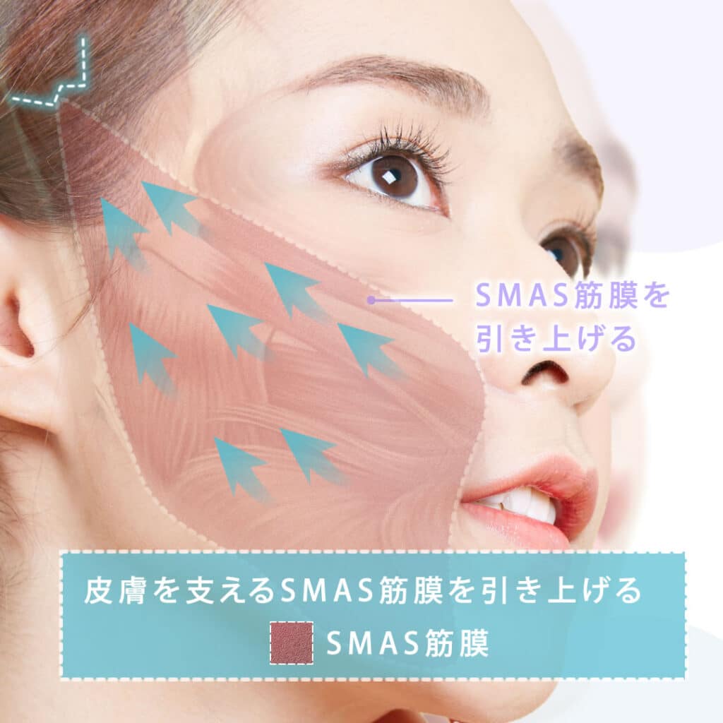 SMAS筋膜を引き上げる図解