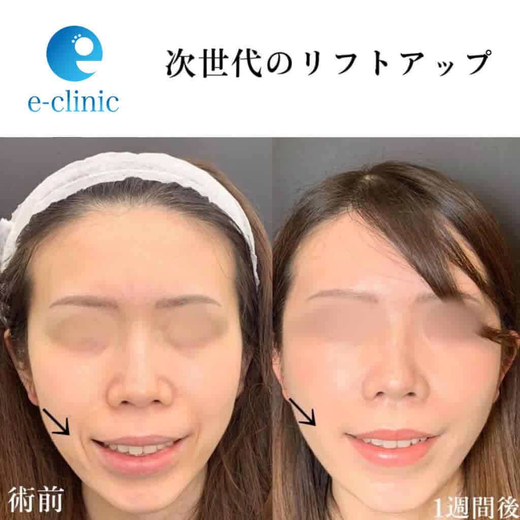 ハイブリッドフェイスリフトの症例写真
