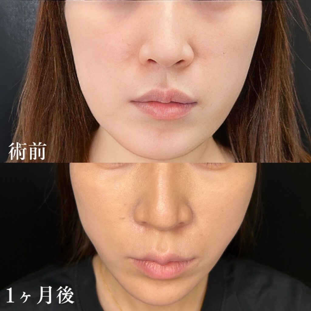 ハイブリッドフェイスリフトの顔下半分の症例