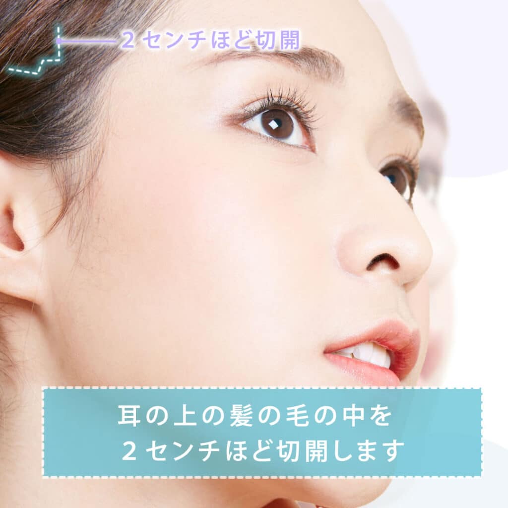 耳の上を切開する図解
