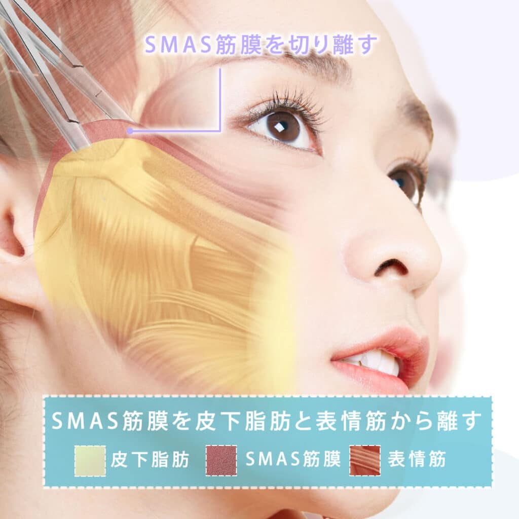 SMAS筋膜を皮下脂肪と表情筋から切り離す図解