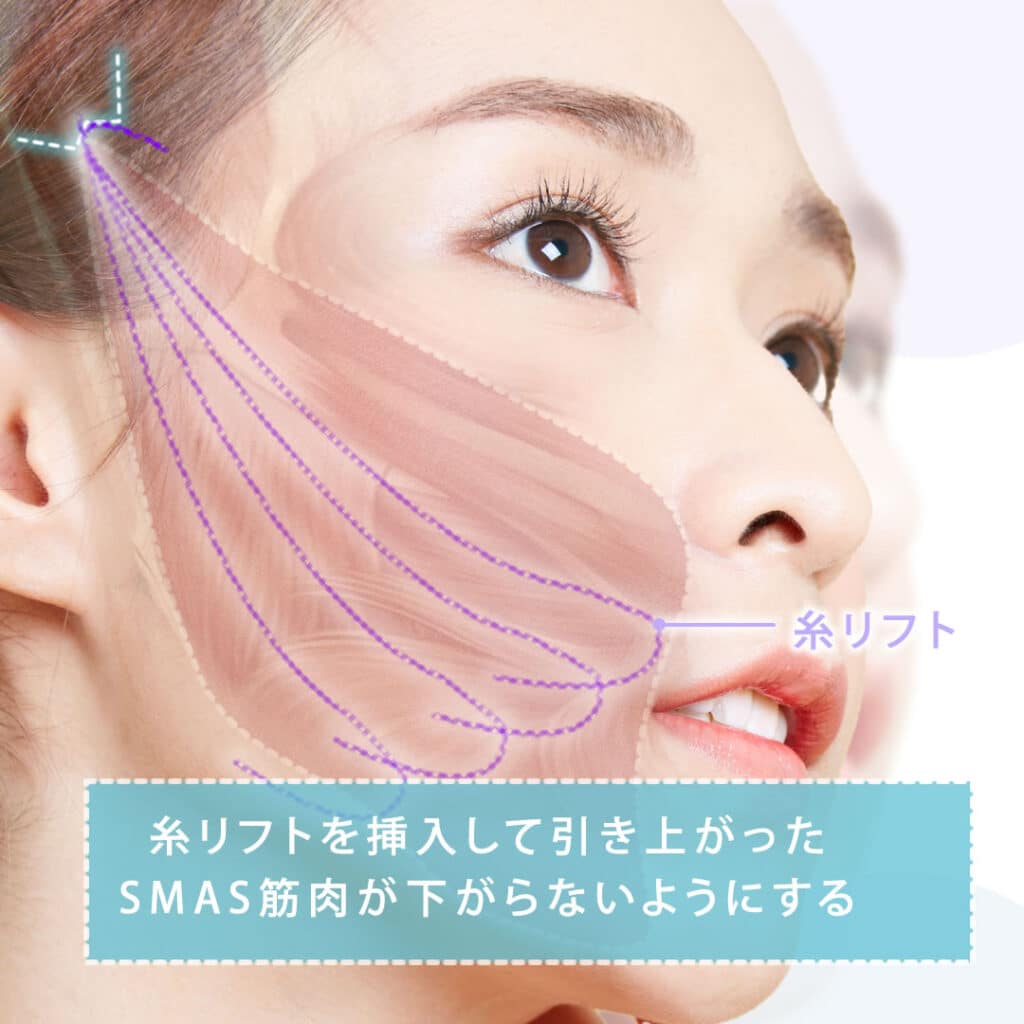 糸リフトを挿入する図解