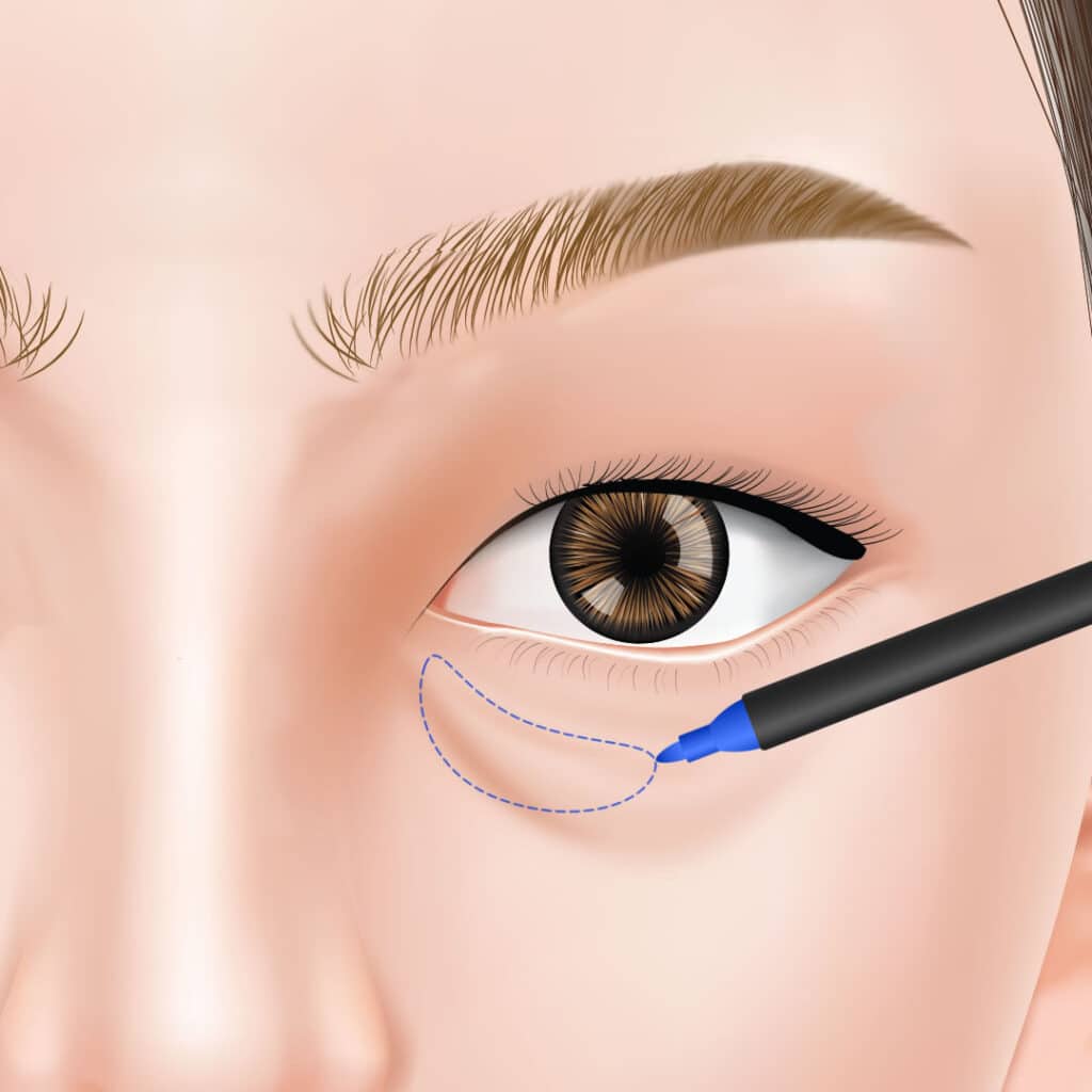 経結膜脱脂のデザインの図解