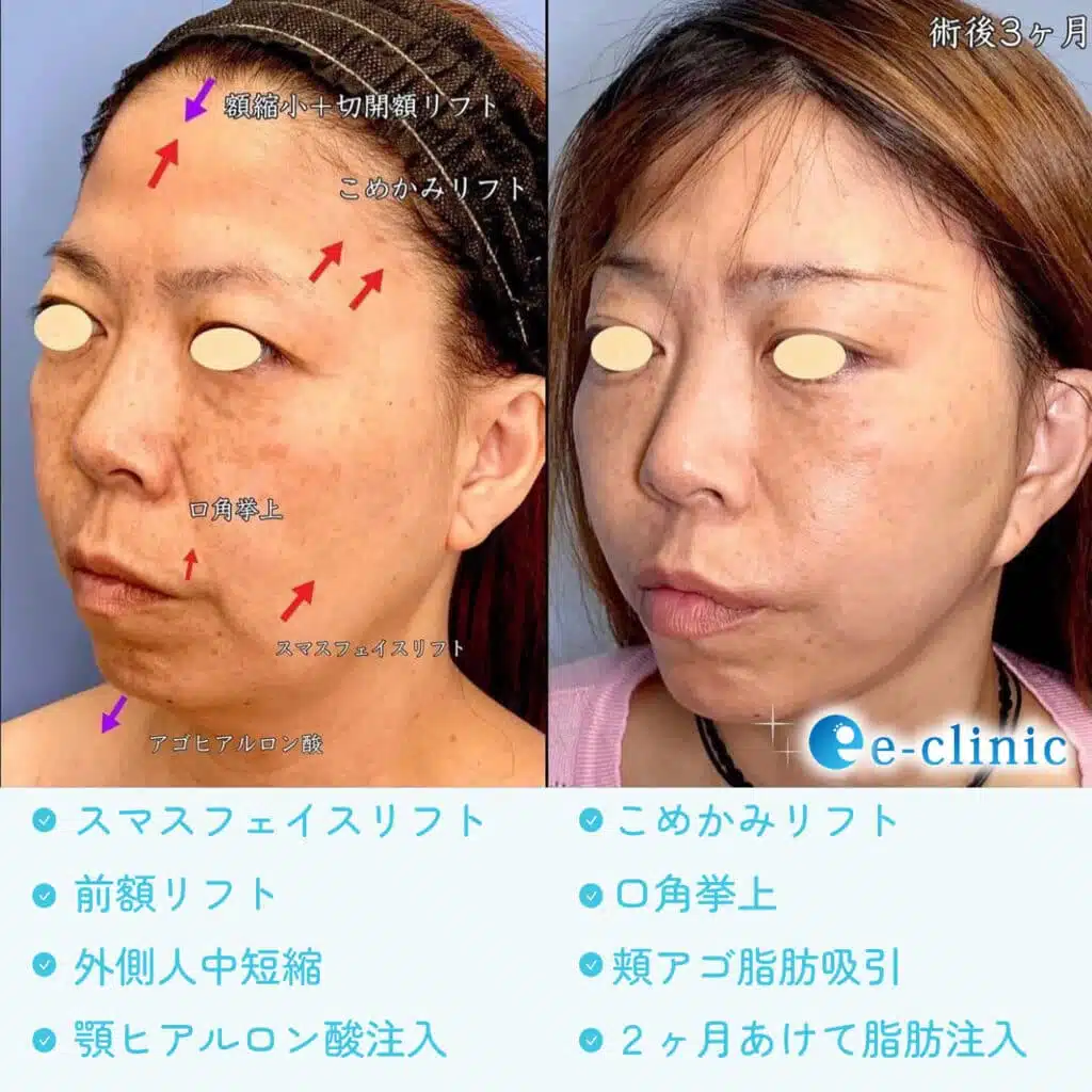 こめかみリフト