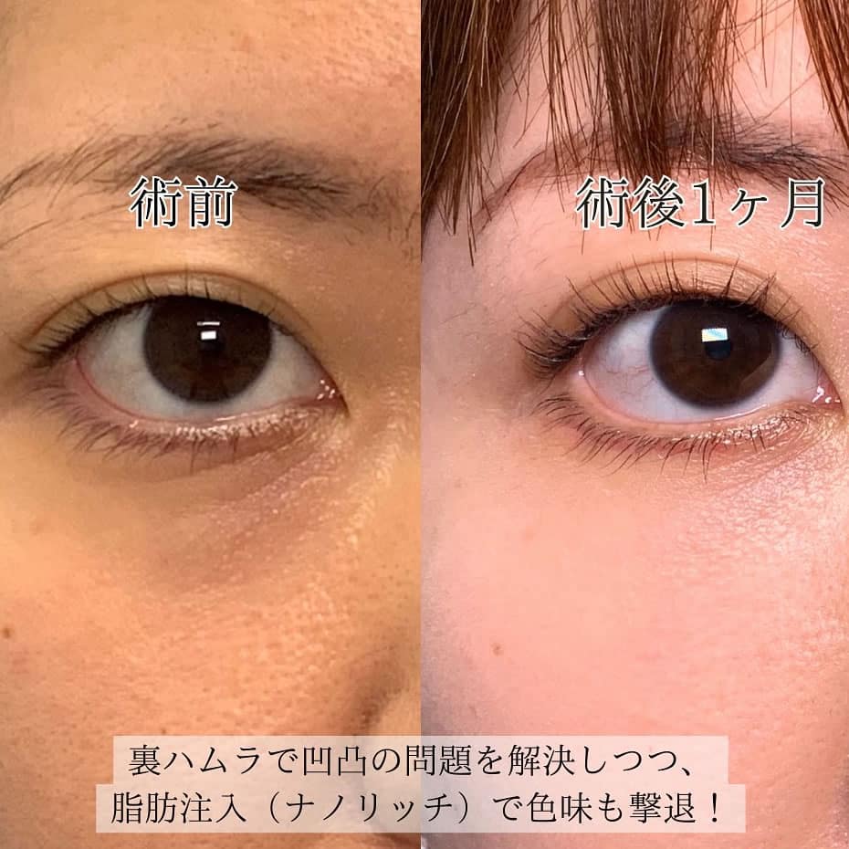 裏ハムラとナノリッチで脂肪注入をした１か月後の症例