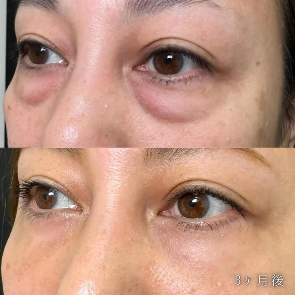 eクリニックの目の下の皮膚切除と裏ハムラとゴルゴラインと目の下のナノリッチの脂肪注入の症例