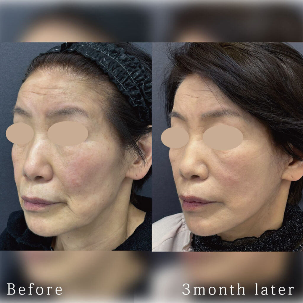 フェイスリフトとバッカルファットリフトの3ヶ月後の症例写真