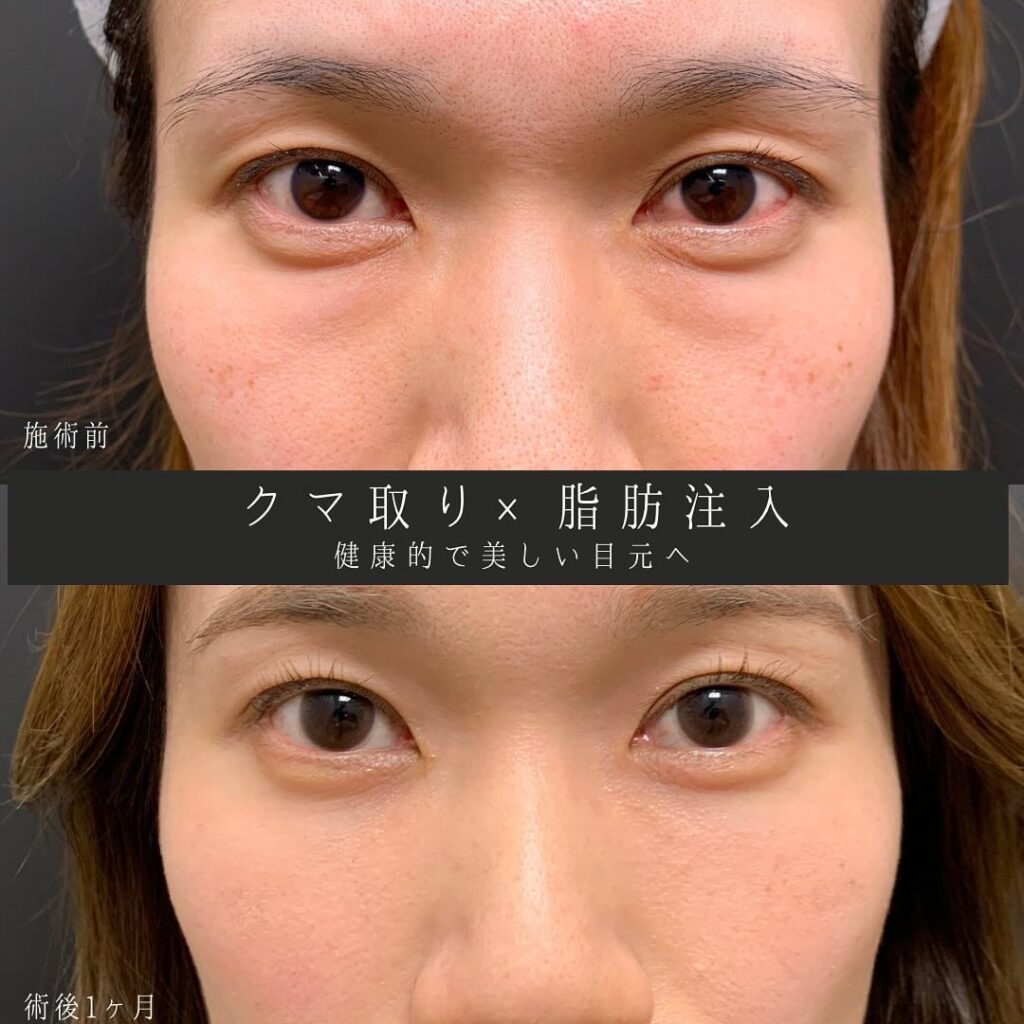 eクリニック富山駅前院のクマ取りと脂肪注入の症例