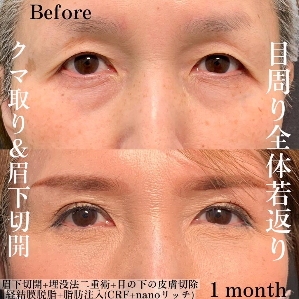 eクリニック富山駅前院の経血膜脱脂の症例写真(4)