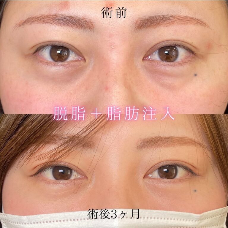 eクリニック富山駅前院の経血膜脱脂の症例写真(5)