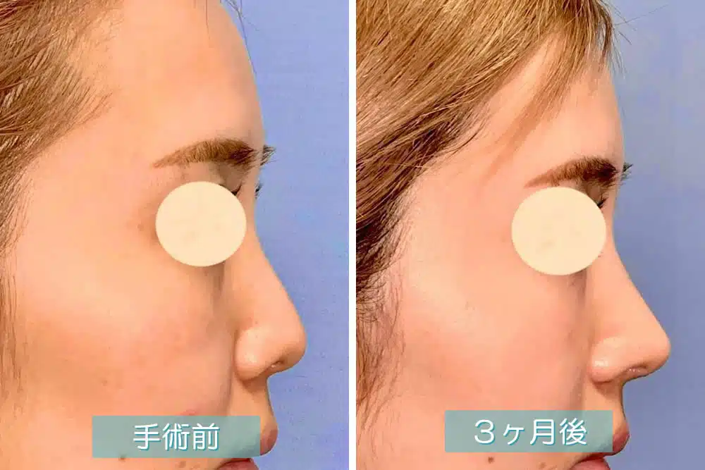 鼻尖部軟骨移植