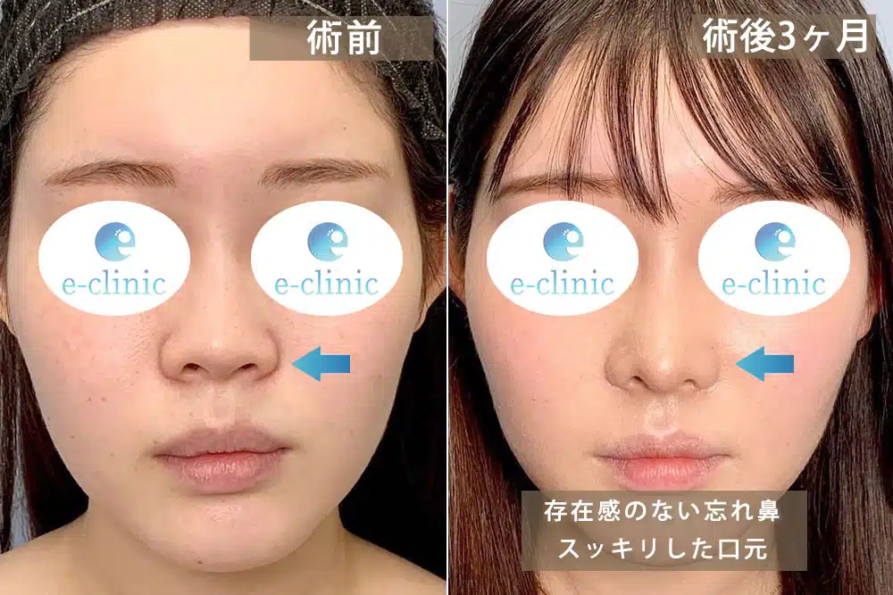 切らない小鼻縮小