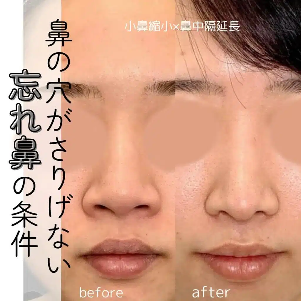 小鼻縮小 鼻中隔延長