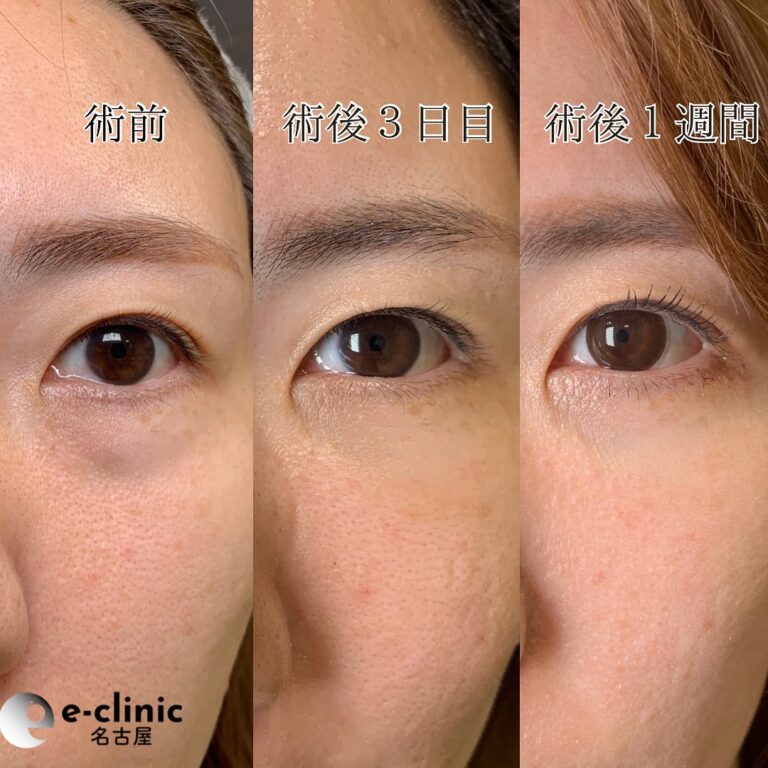 eクリニック富山駅前院の経血膜脱脂の症例写真(6)