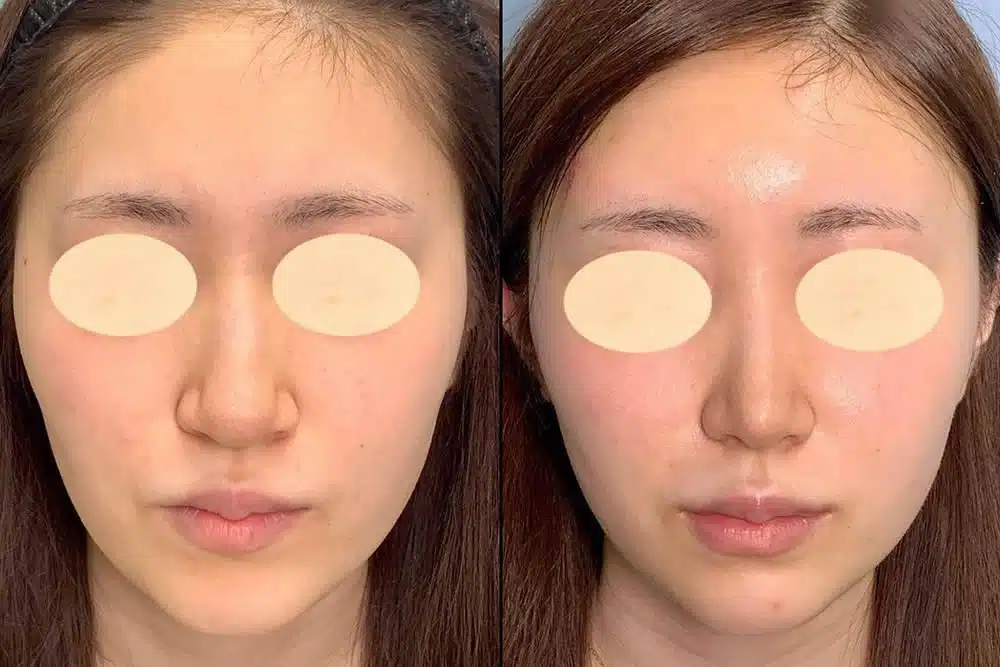 鼻骨骨切り(幅寄せ)