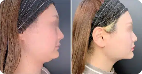 小顔プレミアムプラン