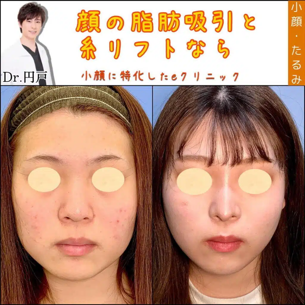 脂肪吸引　糸リフト