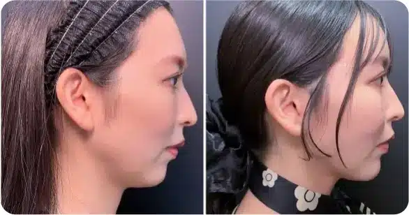 小顔スタンダードプラン