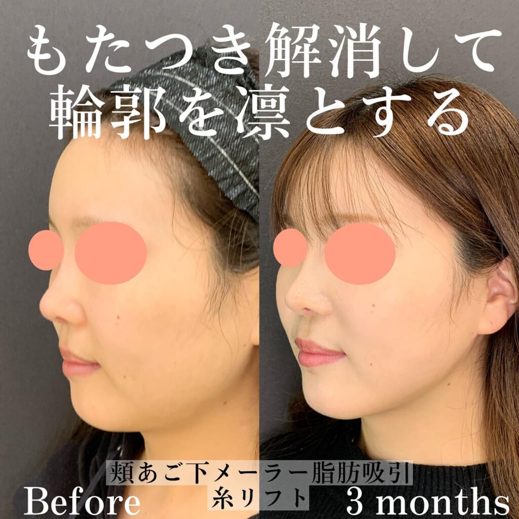 eclinic富山駅前院の糸リフト症例写真